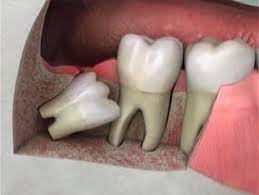răng khôn gây ảnh hưởng đến răng số 7