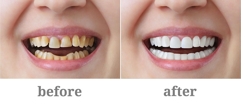 khác nhau trước và sau khi bọc răng