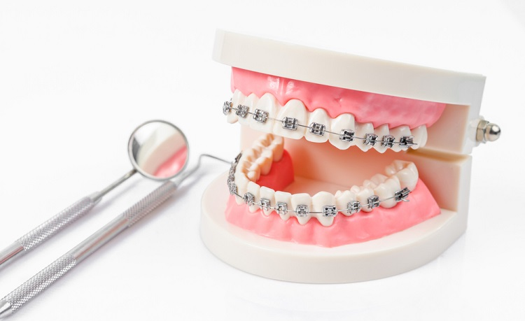 Những lợi ích của việc niềng răng mà bạn chưa biết