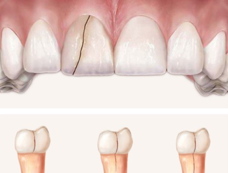 Những tác hại của bọc răng sứ thẩm mỹ không phải ai cũng biết