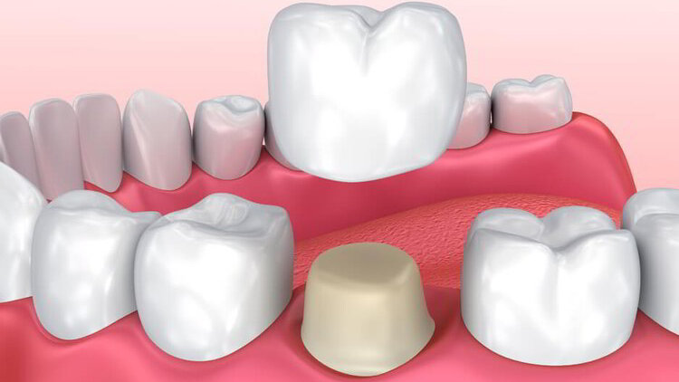 Mách bạn về chế độ ăn uống và chăm sóc răng sau khi bọc răng sứ